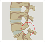 分離症がわかる脊髄のイラスト図